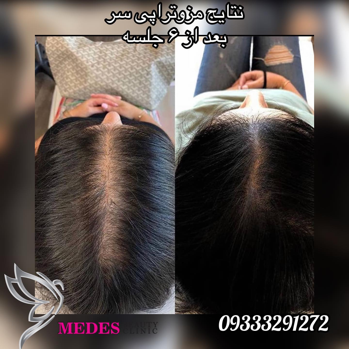 گالری مزوتراپی